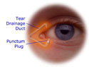 Permanent Punctal Plug