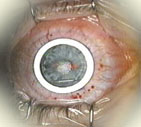lasik - removing the eye tracker ring