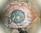 lasik - removing the eye tracker ring