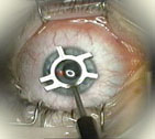 Lasik procedure alignment marks