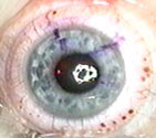 LASIK - eye with flap