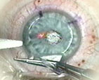 LASIK eye folding back flap